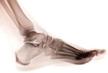 מטופל נותר עם נמק ברגלו לכל חייו